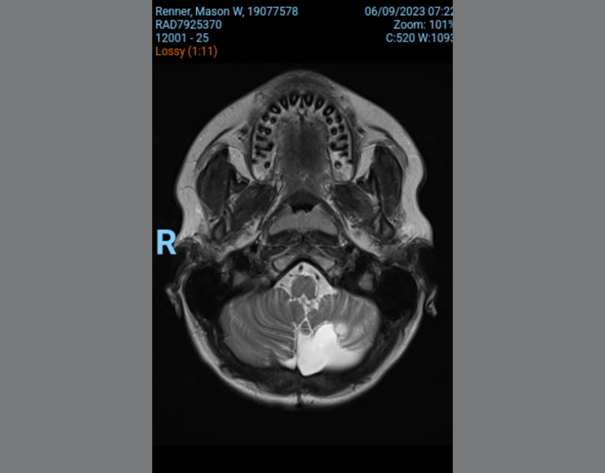 An Xray of Renner's most recent tumor, taken at the doctors office. "I'm glad it's gone to be honest. Now I can return to my normal things." 